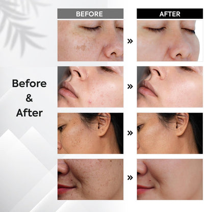 Dark Spot Remover for Face & Body – Sun & Age Spot Corrector, Melasma & Hyperpigmentation Brightening Serum with Roller (0.5 Fl Oz)