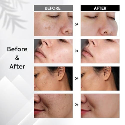 Dark Spot Remover for Face & Body – Sun & Age Spot Corrector, Melasma & Hyperpigmentation Brightening Serum with Roller (0.5 Fl Oz)