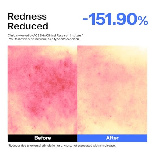 THOME ABC Serum - Azelaic Acid 10% + Niacinamide 5% + Centella Asiatica 1% Triple Synergy Mechanism, Redness Comfort Serum for Dark Spots, Excess Oil & Uneven Texture, Korean Skincare, 1.01 fl oz Avelisse