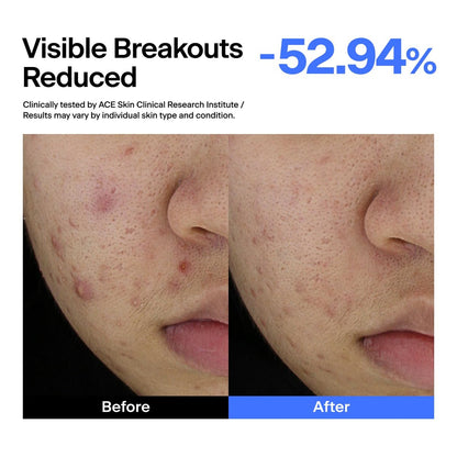 THOME ABC Serum - Azelaic Acid 10% + Niacinamide 5% + Centella Asiatica 1% Triple Synergy Mechanism, Redness Comfort Serum for Dark Spots, Excess Oil & Uneven Texture, Korean Skincare, 1.01 fl oz Avelisse