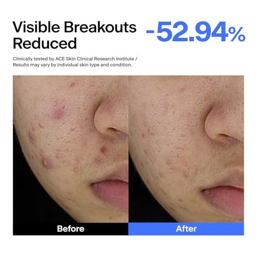 THOME ABC Serum - Azelaic Acid 10% + Niacinamide 5% + Centella Asiatica 1% Triple Synergy Mechanism, Redness Comfort Serum for Dark Spots, Excess Oil & Uneven Texture, Korean Skincare, 1.01 fl oz Avelisse