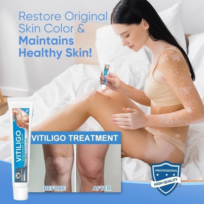 EXVITAMIN Vitiligo Cream – Natural Treatment for Pigmentation & Leukoplakia, Restore Skin Tone for Men & Women (0.7 oz) Avelisse