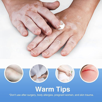 EXVITAMIN Vitiligo Cream – Natural Treatment for Pigmentation & Leukoplakia, Restore Skin Tone for Men & Women (0.7 oz) Avelisse