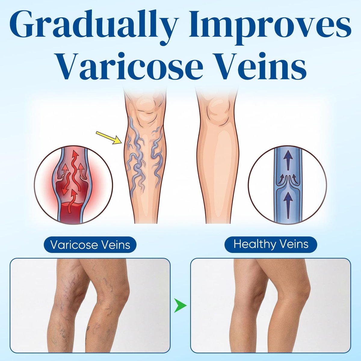 Vein Target Microdarts Patch - Professional Varicose Veins for Legs Patch with Natural Ingredients, 2 Pack Avelisse