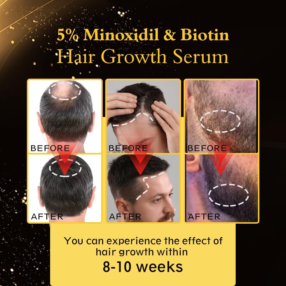 5% Minoxidil Hair Regrowth Oil for Men and Women – Extra Strength Topical Serum for Hair Loss, Promotes Thicker, Healthier Hair and Beard Growth Kit, 2.11 fl.oz (Pack of 2) Avelisse