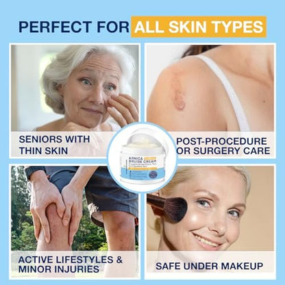 PHARMBANNER Arnica Bruise Cream Extra Strength – Fast-Acting Arnica Montana with Vitamins K, C & E for Bruising, Swelling, Discoloration & Thin Skin – Hydrating Moisturizer for Face & Body – 4 oz Avelisse