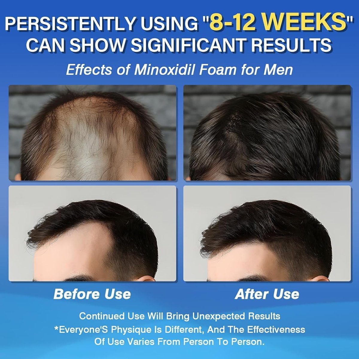 Olassubd Minoxidil 5% Foam for Men Hair Growth – 2.11 oz Avelisse
