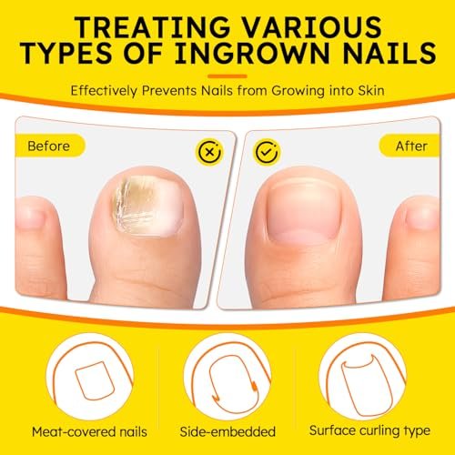 Ingrown Toenail Treatment Kit - Breathable Curved Toenail Corrector Strips with File and Lifter, 60 Pcs for Pain Relief - görsel 14