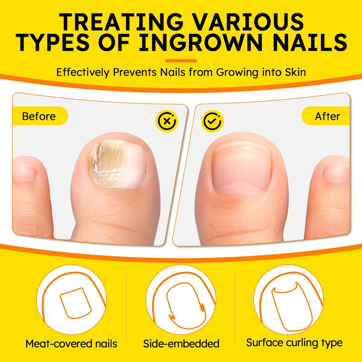 Ingrown Toenail Treatment Kit - Breathable Curved Toenail Corrector Strips with File and Lifter, 60 Pcs for Pain Relief - görsel 13