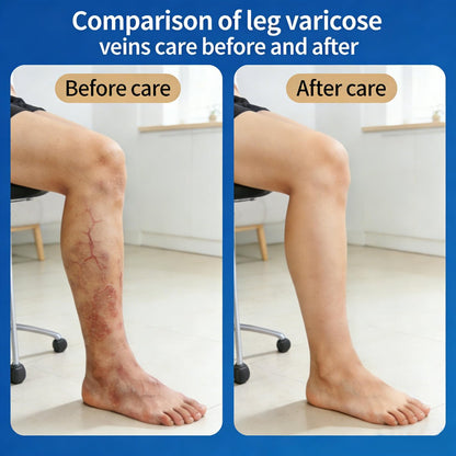 Vein Ease Microdarts Care Patch - 2 Boxes Professional Varicose Veins Treatment for Legs, Natural Ingredients, Improves Blood Circulation, Suitable for All Skin Types Avelisse