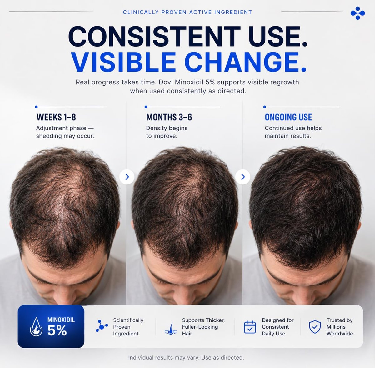 Dovi Minoxidil 5% Hair Regrowth Treatment for Men – Extra Strength Advanced Topical Solution, 6 Month Supply Avelisse