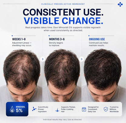 Dovi Minoxidil 5% Hair Regrowth Treatment for Men – Extra Strength Advanced Topical Solution, 6 Month Supply Avelisse