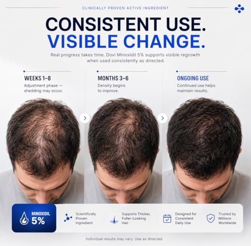 Dovi Minoxidil 5% Hair Regrowth Treatment for Men – Extra Strength Advanced Topical Solution, 6 Month Supply Avelisse