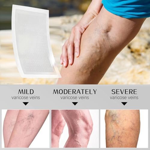 VeinTarget Microdarts Patch – Professional Varicose Veins Treatment for Legs, Natural Ingredients, All Skin Types (1 Pack) Avelisse