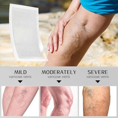 VeinTarget Microdarts Patch – Professional Varicose Veins Treatment for Legs, Natural Ingredients, All Skin Types (1 Pack) Avelisse