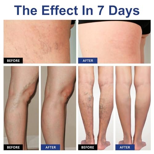 VeinTarget Microdarts Patch – Professional Varicose Veins Treatment for Legs, Natural Ingredients, All Skin Types (1 Pack) Avelisse