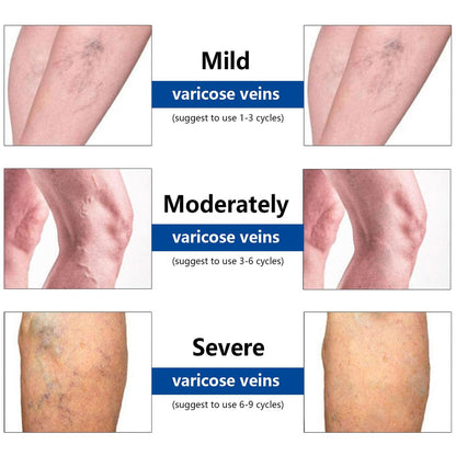 VeinTarget Microdarts Patch – Professional Varicose Veins Treatment for Legs, Natural Ingredients, All Skin Types (1 Pack) Avelisse