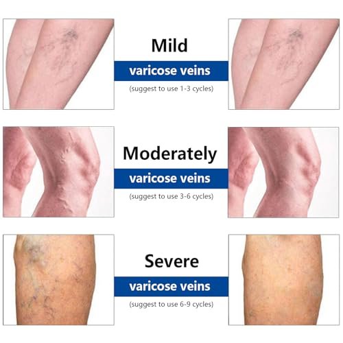 VeinTarget Microdarts Patch – Professional Varicose Veins Treatment for Legs, Natural Ingredients, All Skin Types (1 Pack) Avelisse