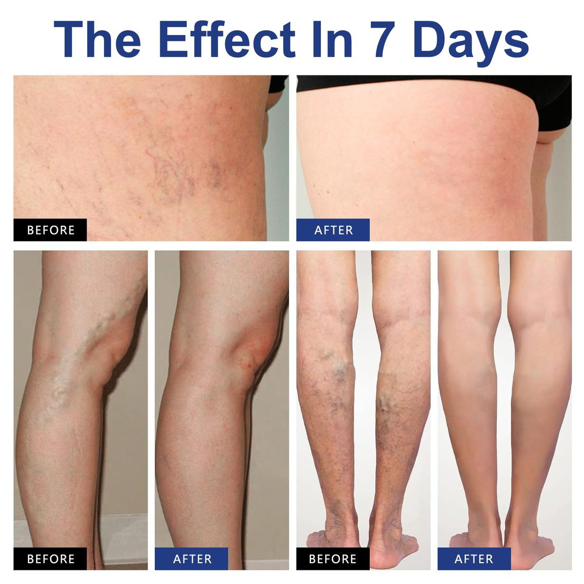 VeinTarget Microdarts Patch – Professional Varicose Veins Treatment for Legs, Natural Ingredients, All Skin Types (1 Pack) Avelisse