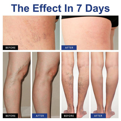 VeinTarget Microdarts Patch – Professional Varicose Veins Treatment for Legs, Natural Ingredients, All Skin Types (1 Pack) Avelisse