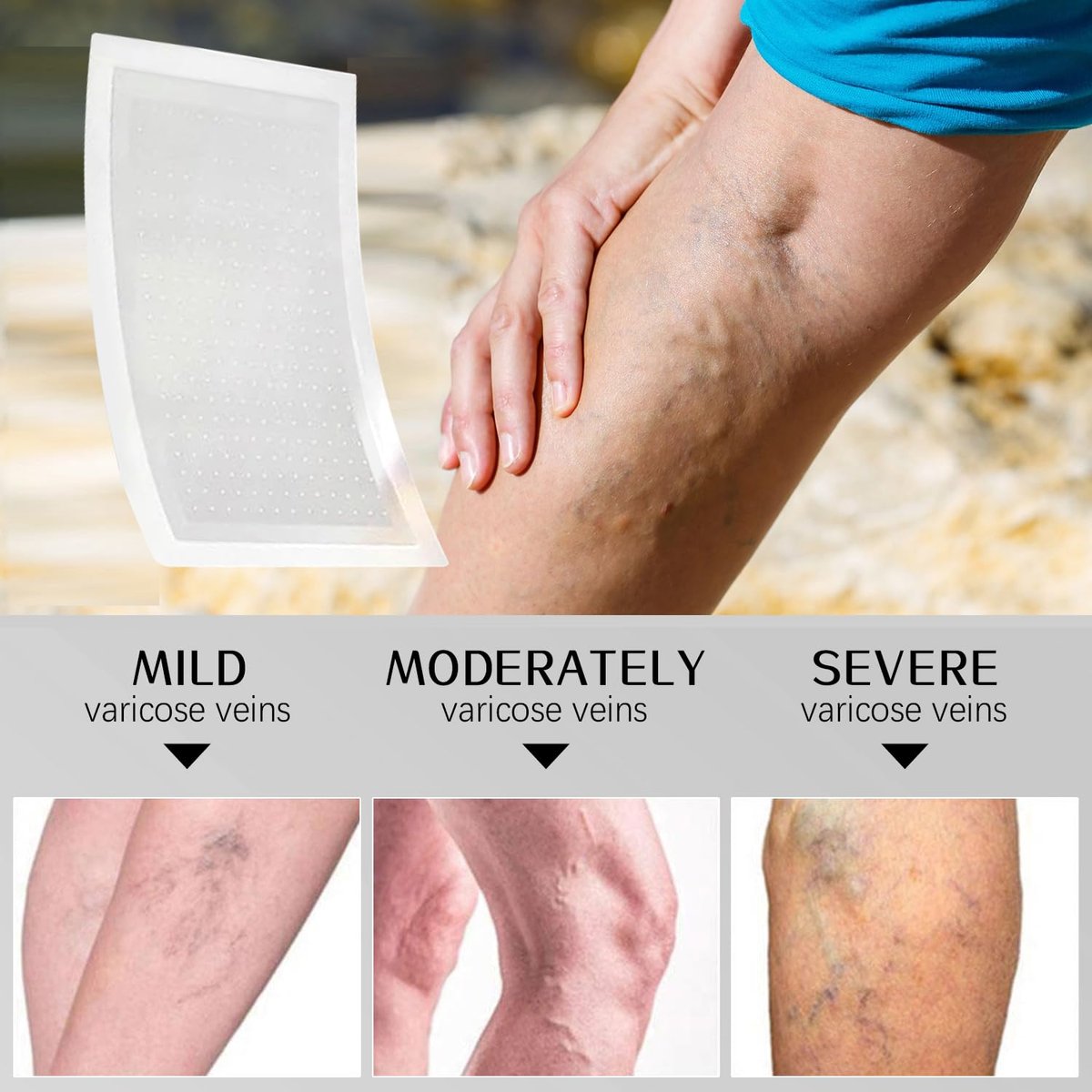 VeinTarget Microdarts Patch – Professional Varicose Veins Treatment for Legs, Natural Ingredients, All Skin Types (1 Pack) Avelisse