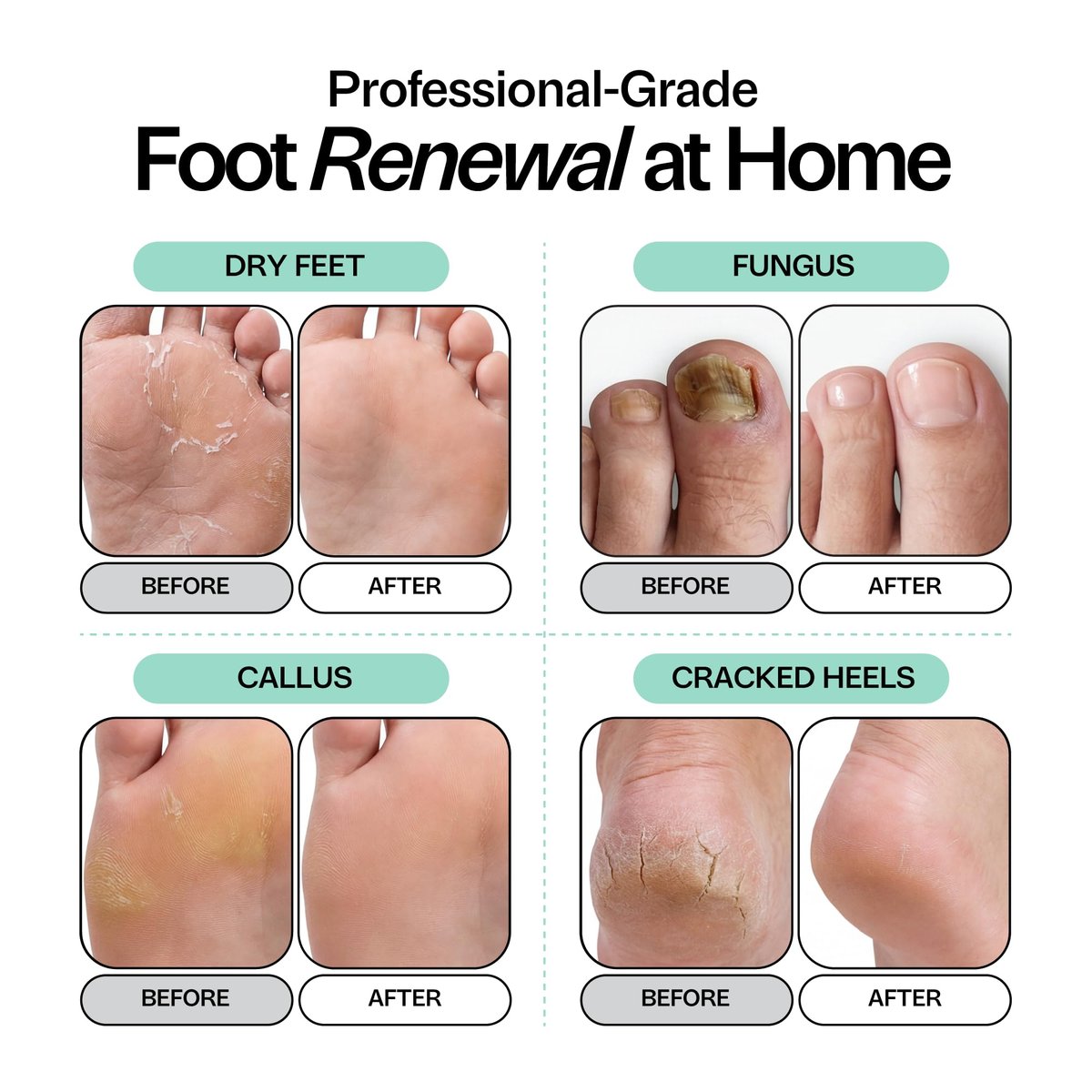 Foot Choice Tea Tree Oil Foot Soak with Epsom Salt - Toenail Repair, Odor Elimination & Callus Softening - Soothes Tired, Sore Feet & Itchy Skin - Made in USA, 16 oz - görsel 5